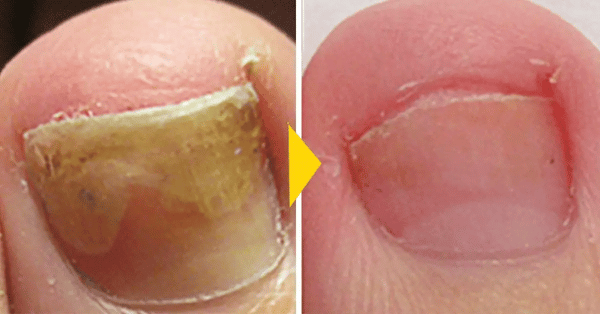 Patch Reparare Unghii Picioare