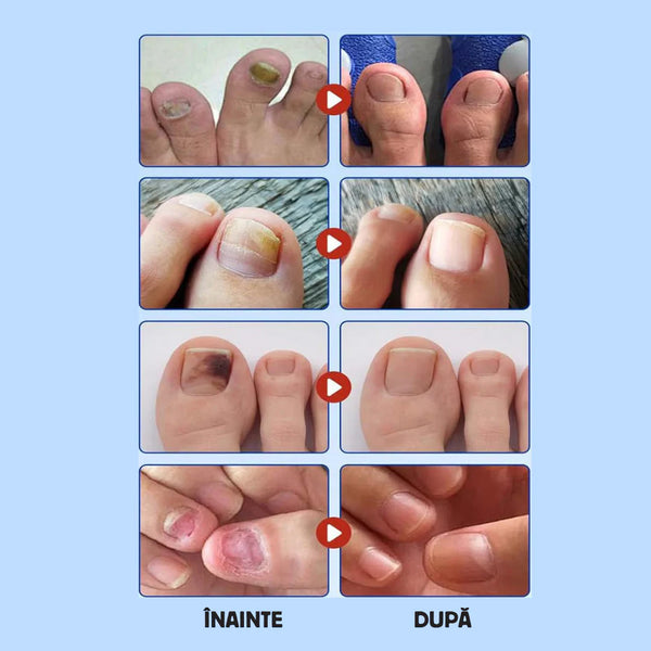 Plasturi pentru ciuperca unghiei